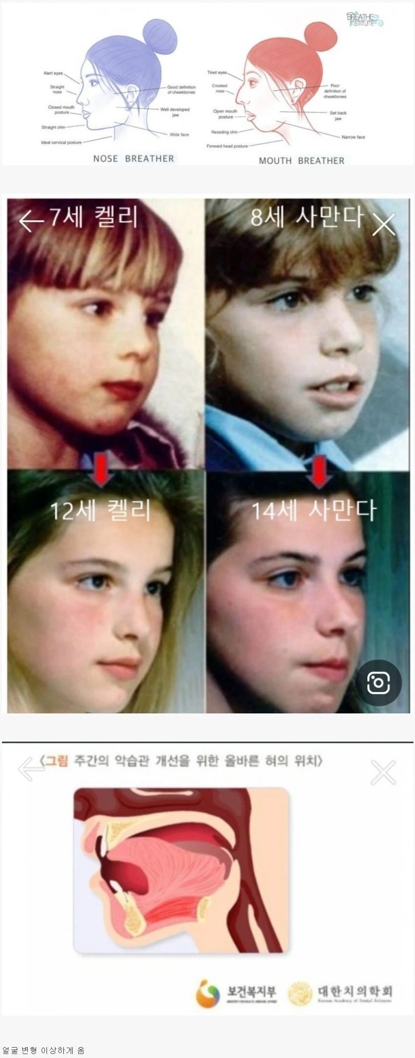 어릴때 입으로 숨쉬면서 자면 안좋은 이유