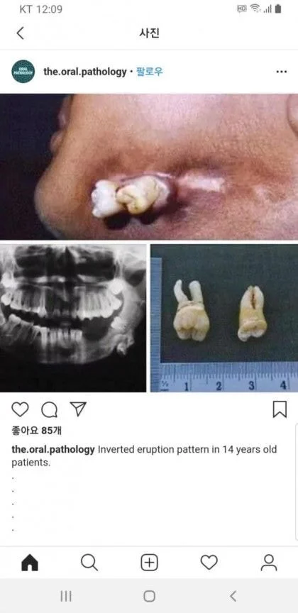 혐) 사랑니가 예상할수 없는 치아인 이유