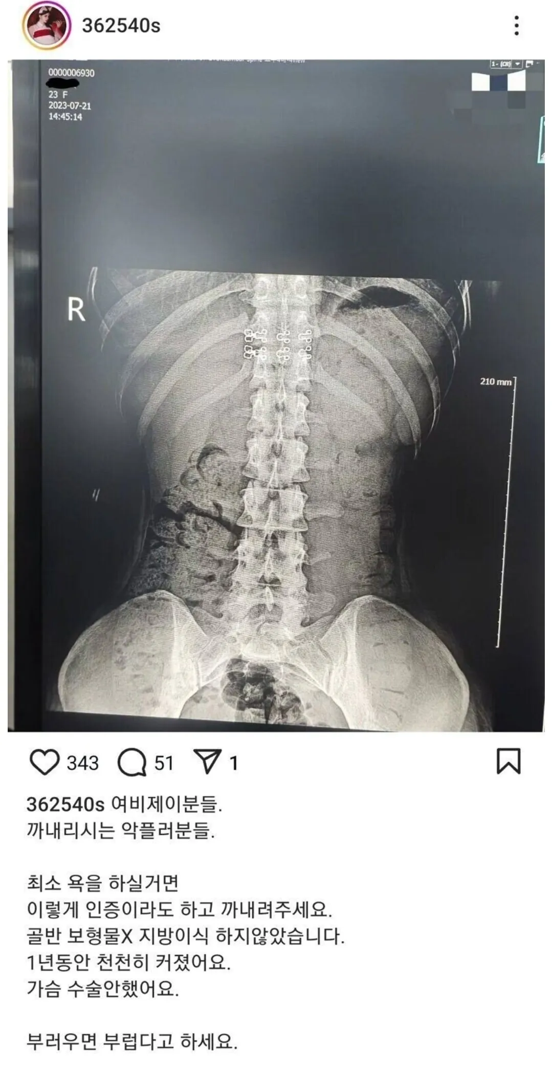 빡쳐서 자연산 골반 인증하는 BJ