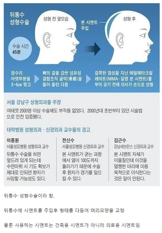요즘 몇몇 강남 성형외과에서 많이 하는 수술