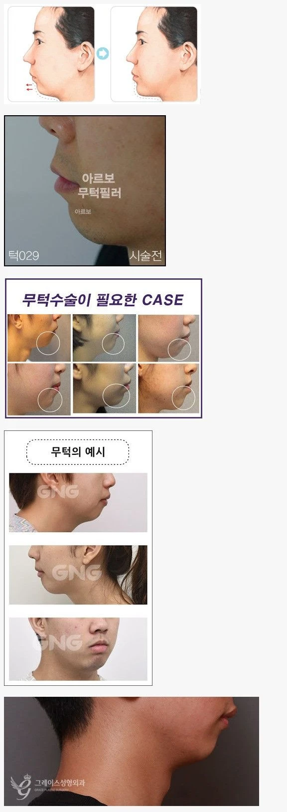무턱 성형이 필요한 이유